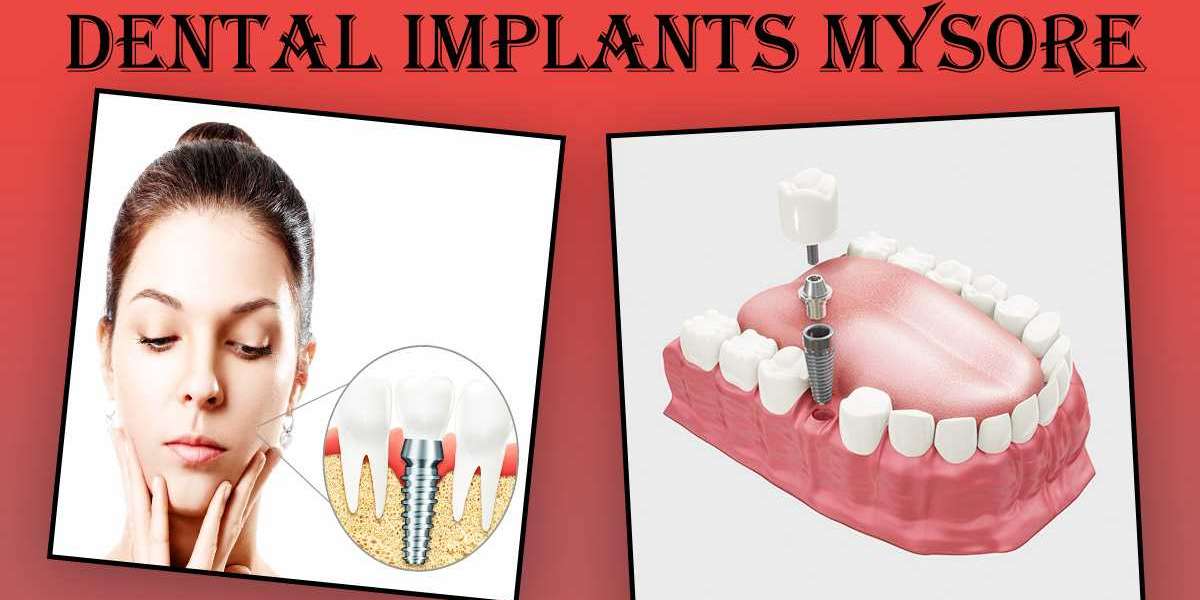 Best Dental Implants in Mysore | Best Implantologist