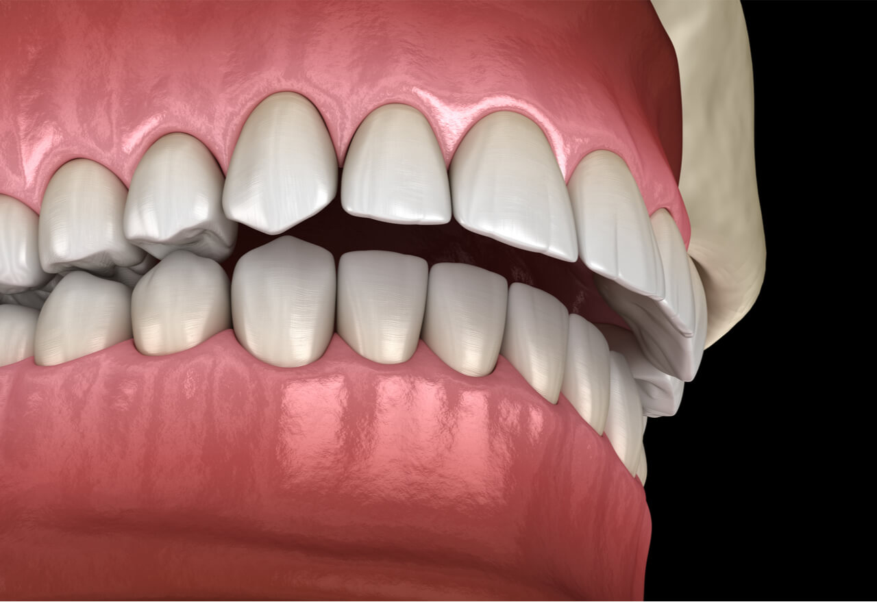 Sobremordida: Diferencias entre Invisalign y brackets - Grupo Gente Vital
